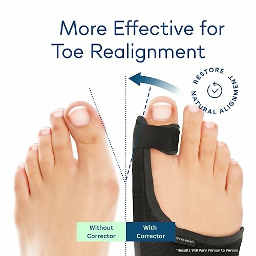 Comparison of toes with and without a corrector for alignment